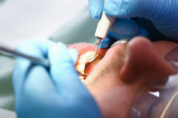 Best Chipped Tooth Repair Near Me  in Cloverdale, CA